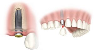 "Dental-Implant-Murah-di-Jakarta"