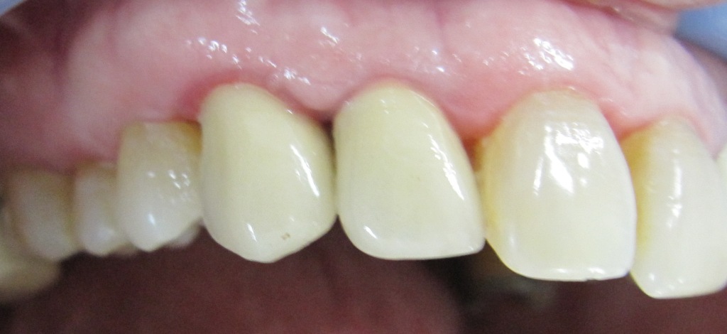 Jenis dan Bahan Gigi Palsu  Audy Dental