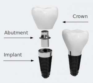 "dental-implant-di-jakarta"