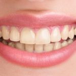 klinik-pemutihan-gigi-di-jakarta (2)