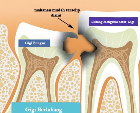 Biaya Operasi Gigi Bungsu Audy Dental