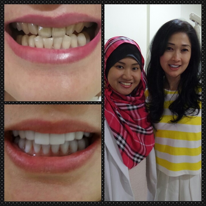 Veneer Gigi  Kelinci di Jakarta Audy Dental