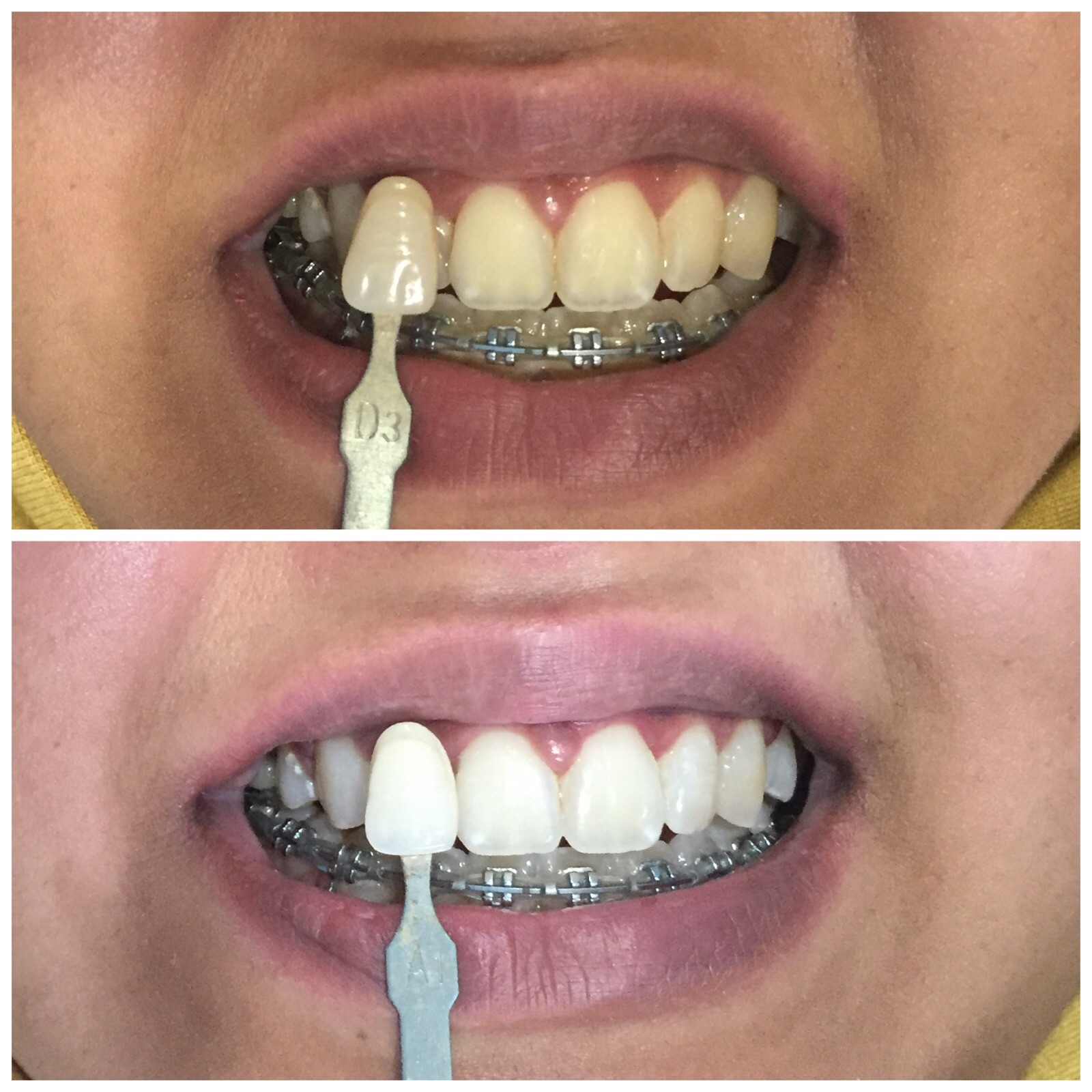 hasil pemutihan gigi bleaching audy dental 4 Audy Dental