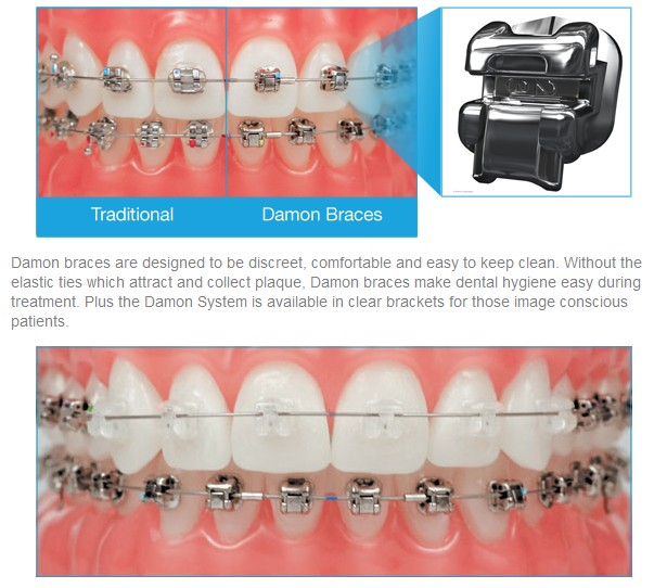 Kawat Gigi Teknologi Terbaru dengan Damon  System Audy Dental