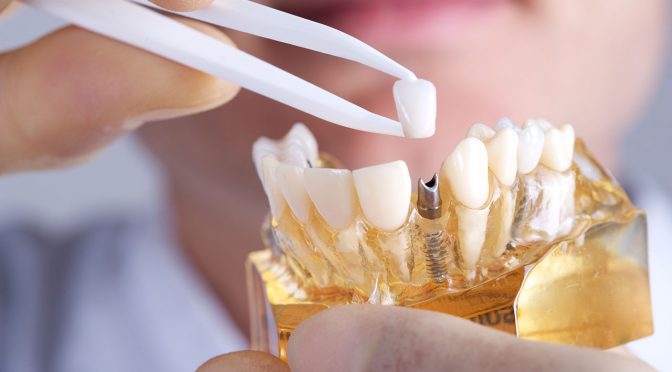 Mengenal proses implan gigi dan prosedurnya Audy Dental