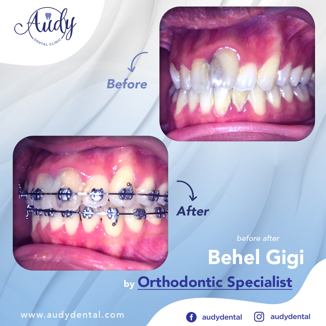  Behel  Metal  Audy Dental