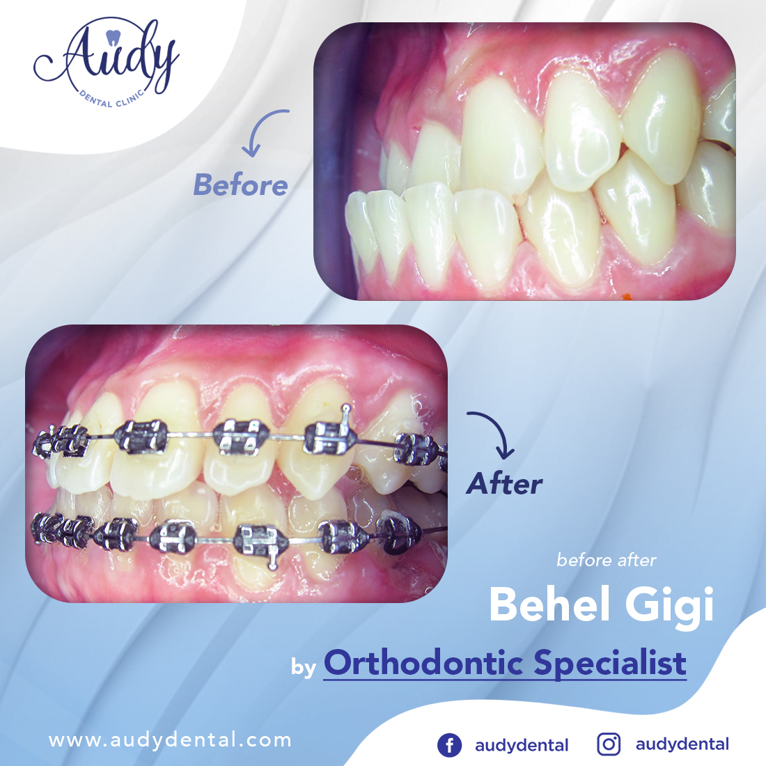 Behel  Metal  Audy Dental