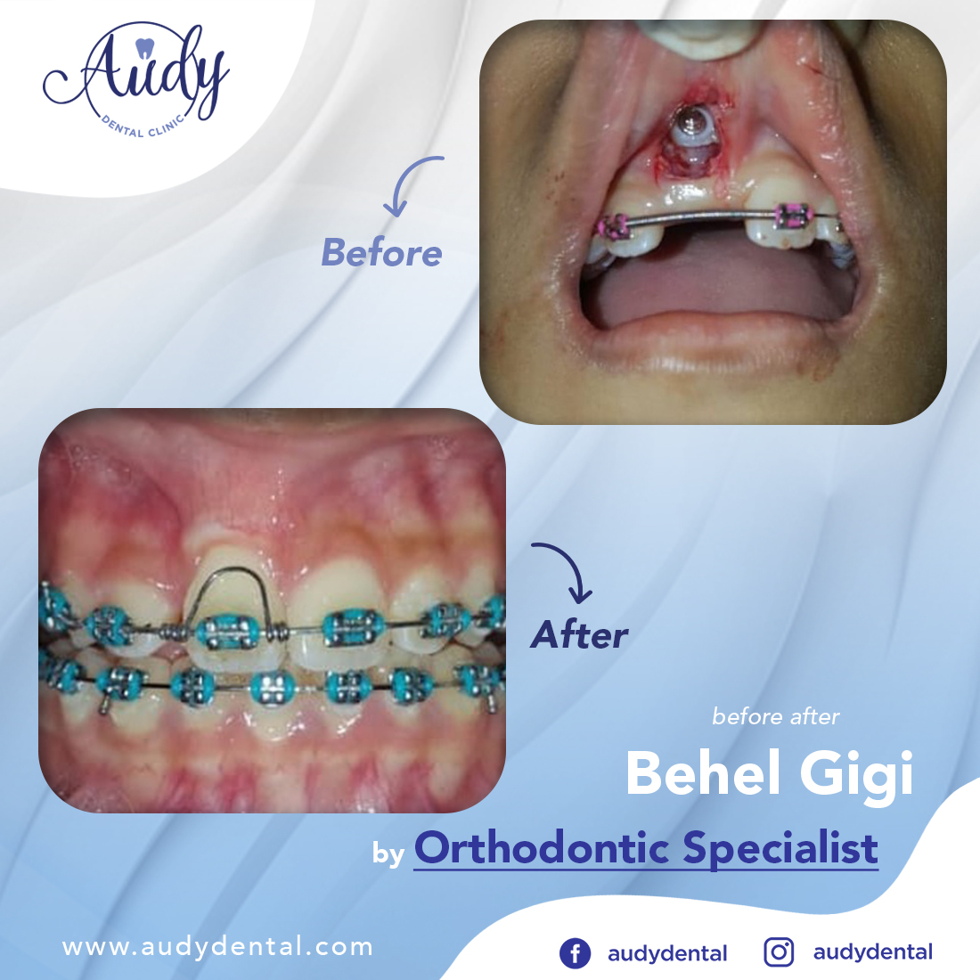  Behel  Gigi Audy Dental 
