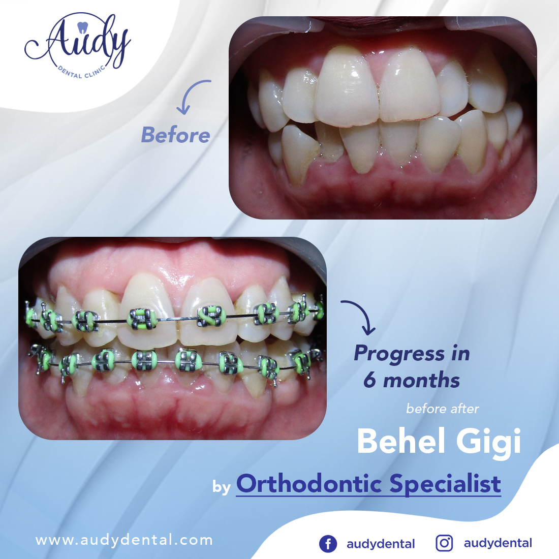 Behel Metal Audy Dental