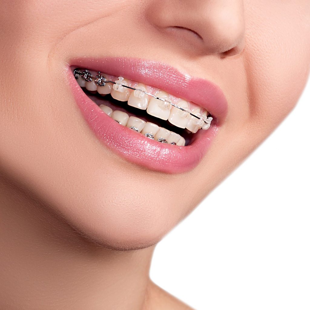  ceramic braces  audy dental Audy Dental