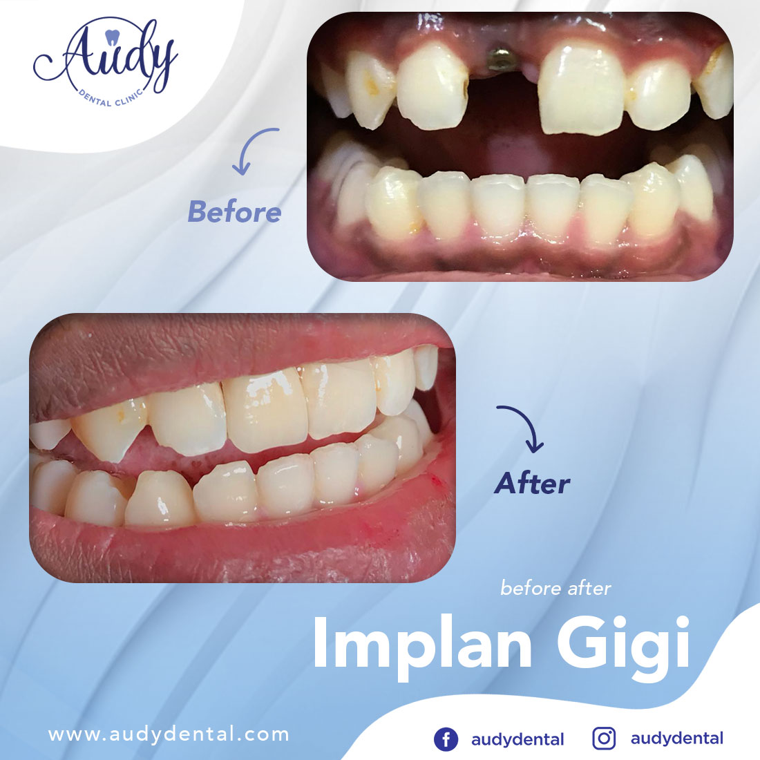 Implan Gigi Audy Dental