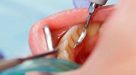 scaling gigi di audy dental