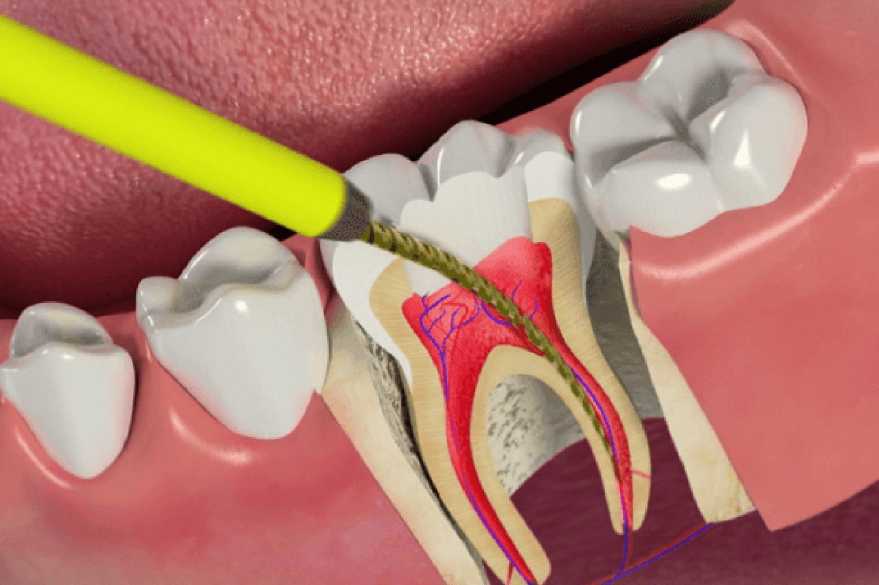 После эндодонтического лечения. 4 Канальный пульпит зуба. Двухканальный пульпит. Пульпит пломбировка каналов.