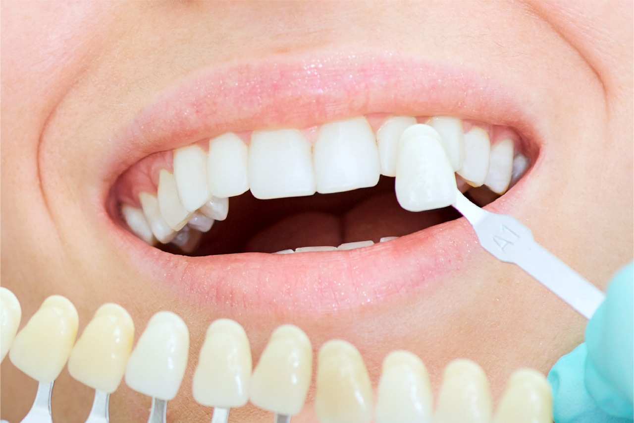 Rahasia Pemutihan Gigi yang Tahan Lama