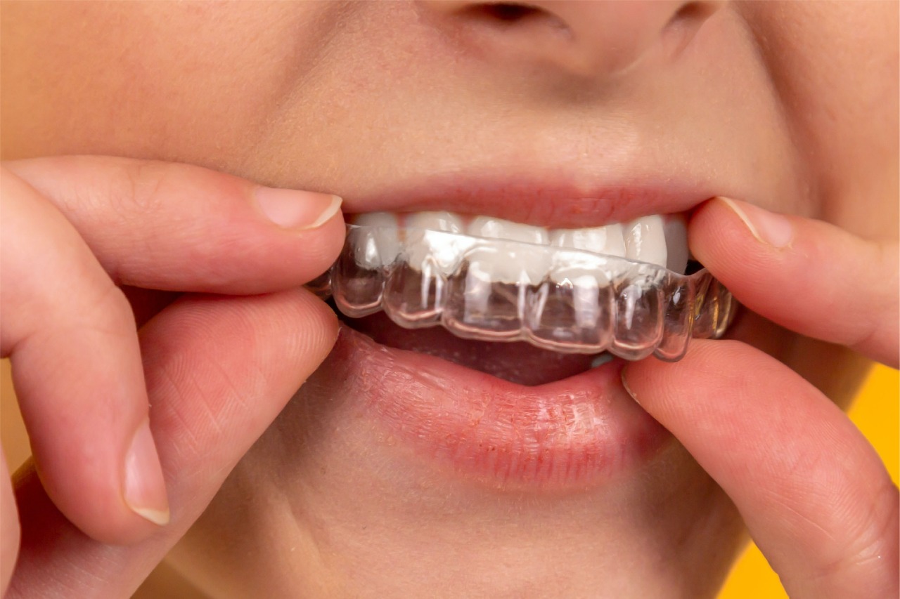 Clear Aligner: Teknologi Terbaru untuk Merapikan Gigi