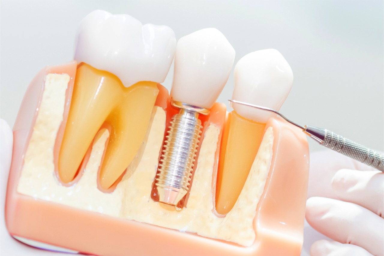 Pentingnya Pasang Gigi Palsu Permanen untuk Mengganti Gigi yang Hilang