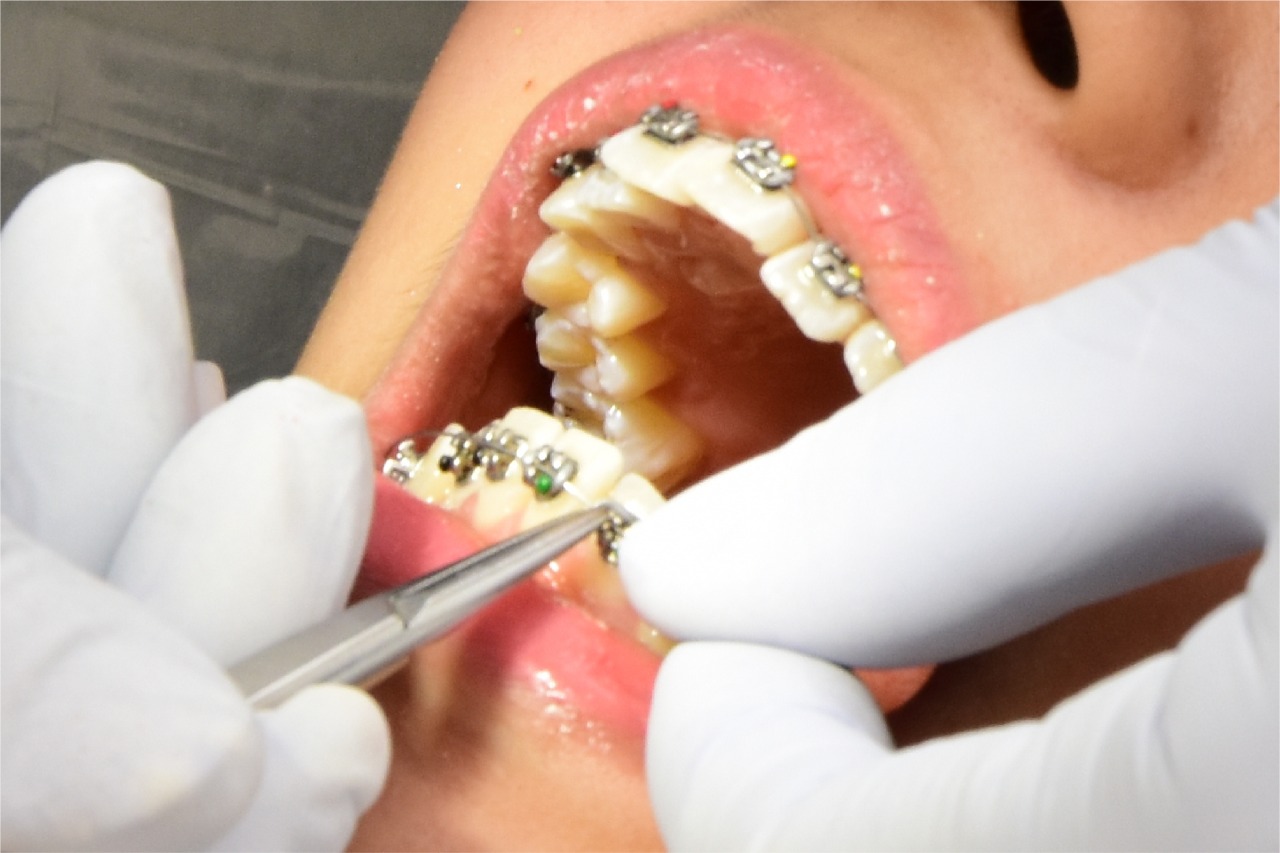 4 Alasan Pasang Behel Gigi di Klinik Spesialis