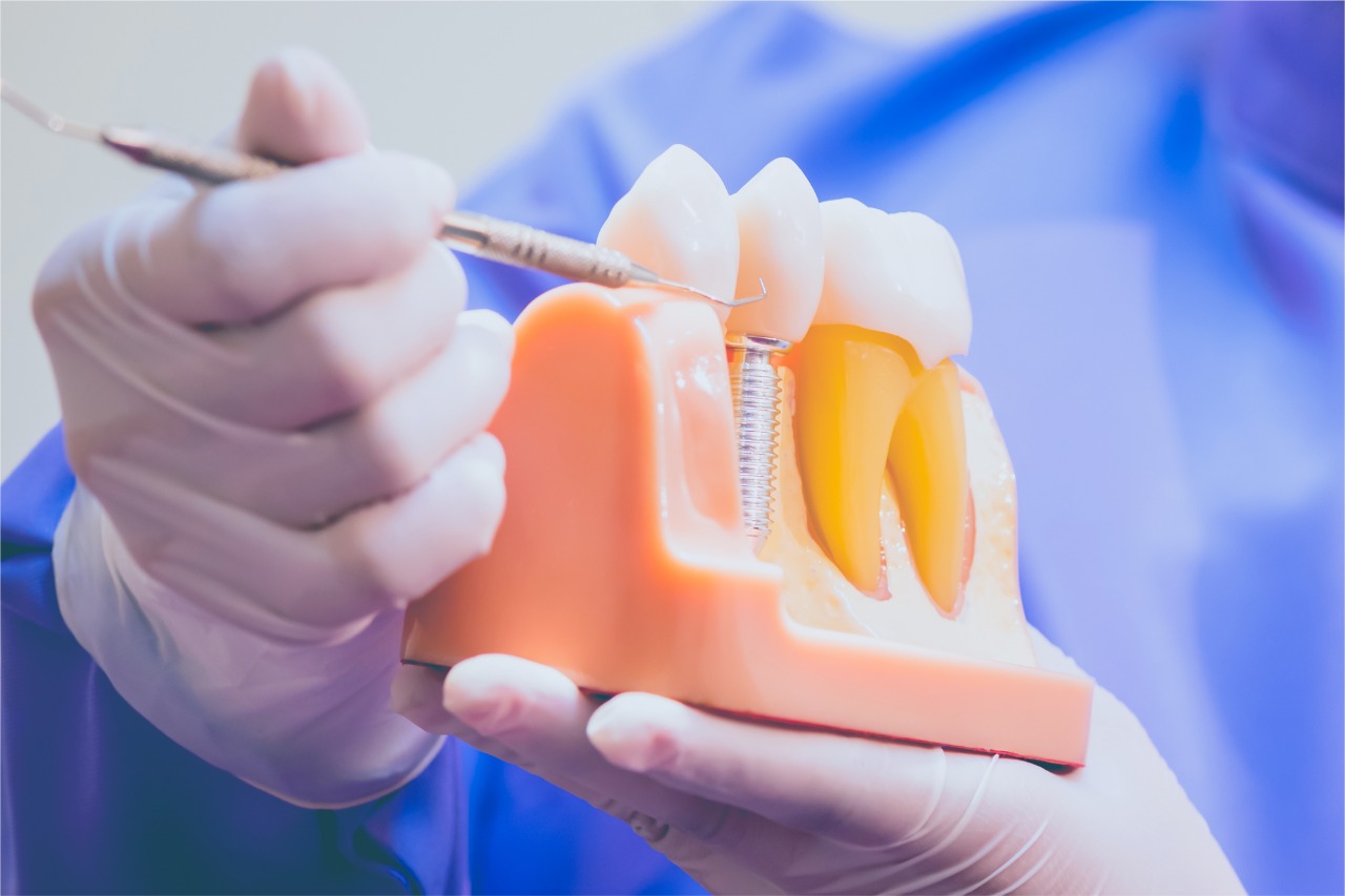 Kenali Mitos Pasang Gigi Palsu Implan yang Beredar