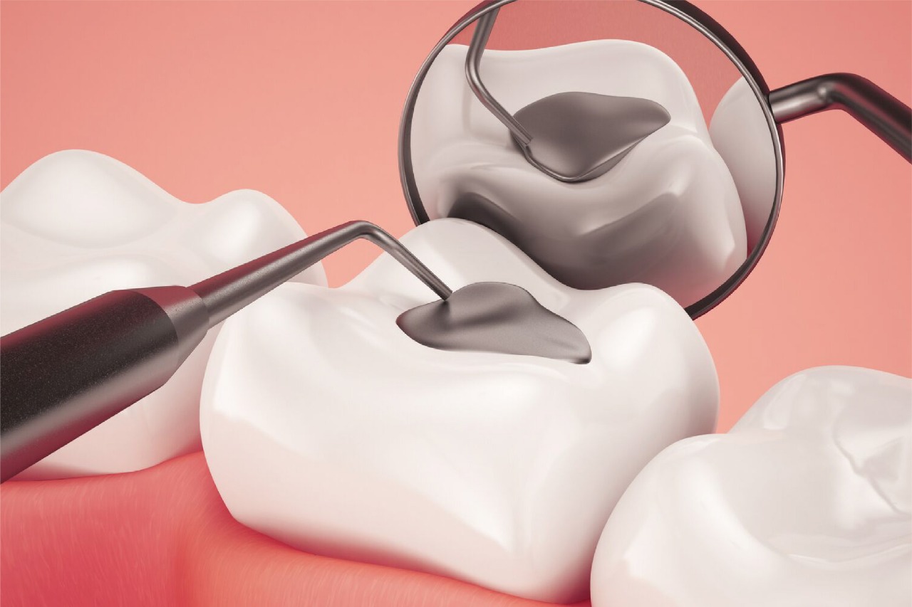 Bahan, Prosedur, dan Biaya Tambal Gigi yang Perlu Diketahui