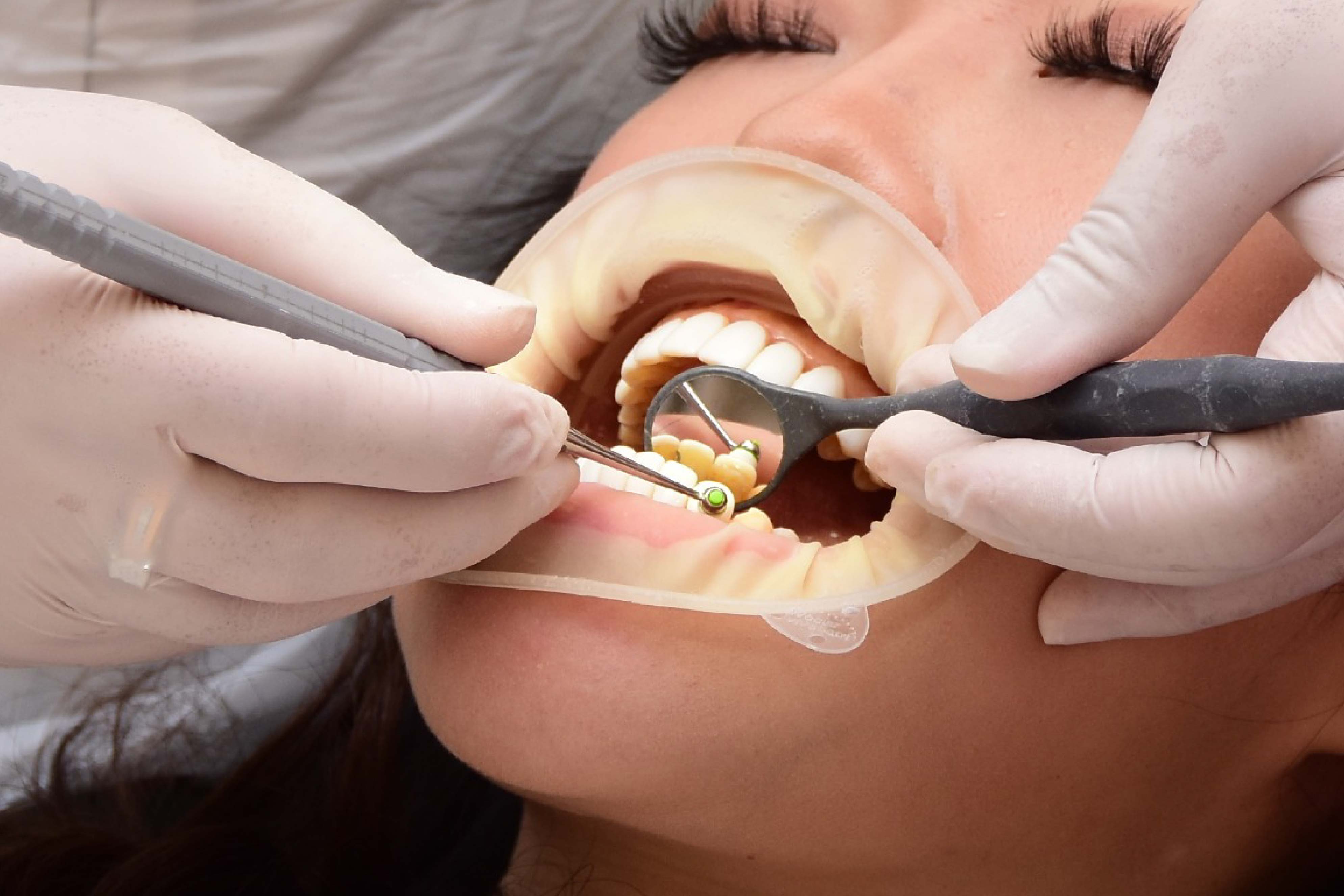 Manfaat Pasang Veneer Gigi Di Audy Dental