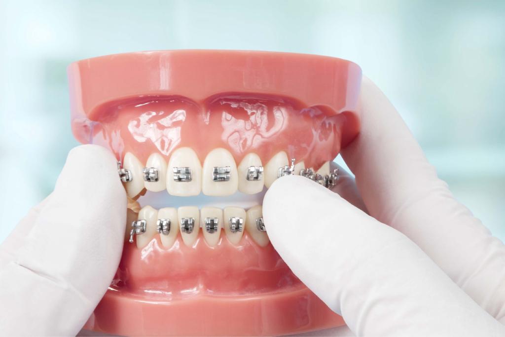 Cari Tahu Harga Behel dan Kondisi Gigi yang Memerlukan Pemasangan Behel