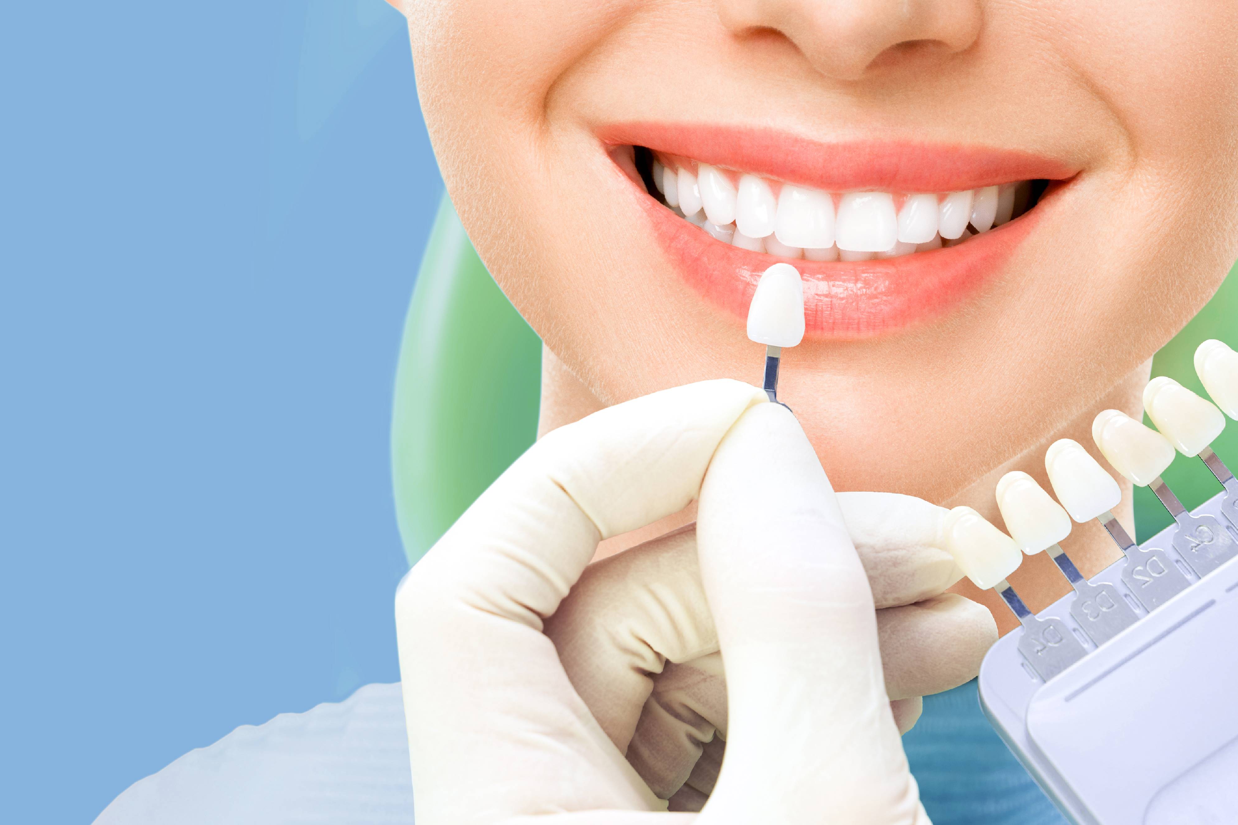 Keuntungan Pasang Veneer Gigi di AUDY Dental Cabang Semarang